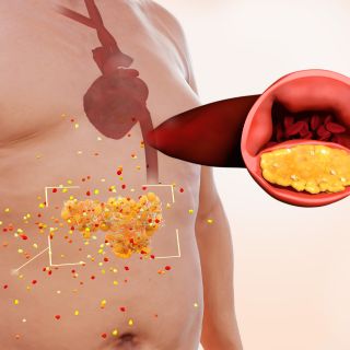 Previene l'Ipertensione e l'Aterosclerosi